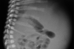 ascitis-congenita-2002-002