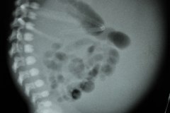 ascitis-congenita-2002-003