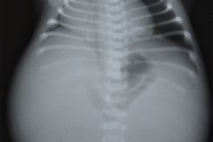 ascitis-congenita-abdomen-batracio-1988-000