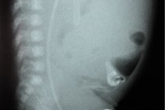 ascitis-dren-penrose-cateter-femoral-der-2002-001