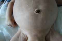 ascitis-hidrocele-bilateral-2002-000