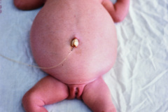 ascitis-neonatal-drenaje-1990-004