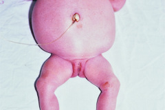 ascitis-neonatal-drenaje-1990-005