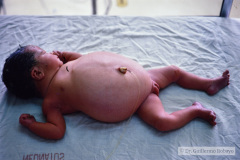 ascitis-neonatal-drenaje-1990-007