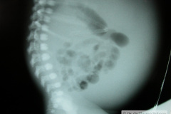 ascitis-puncion-denaje-hidrocele-edema-prepucio-2002-003