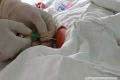 ascitis-puncion-denaje-hidrocele-edema-prepucio-2002-013