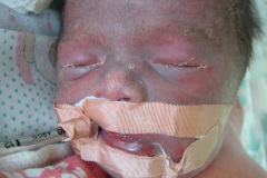 ascitis-puncion-denaje-hidrocele-edema-prepucio-2002-014
