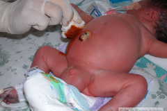 ascitis-puncion-denaje-hidrocele-edema-prepucio-2002-015