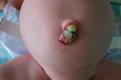 ascitis-puncion-denaje-hidrocele-edema-prepucio-2002-017
