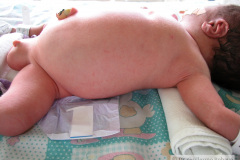 ascitis-puncion-denaje-hidrocele-edema-prepucio-2002-019