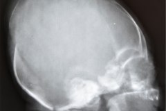 asinclitismo-depresion-parietal-1989-001