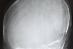 asinclitismo-depresion-parietal-1989-002