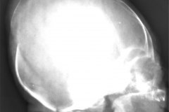 asinclitismo-depresion-parietal-1989-005