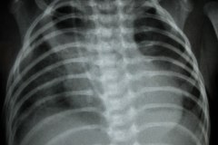 atelectasia-apical-der-secuestro-y-quiste-pulmonar-000