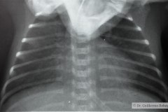 atelectasia-masiva-pulmon-izq-sobreinsercion-tubo-2000-000