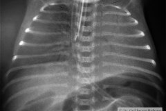 atelectasia-masiva-pulmon-izq-sobreinsercion-tubo-2000-001