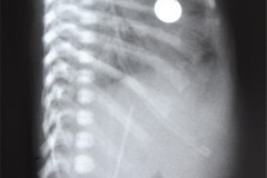 atelectasia-total-pulmonar-izq-tubo-endotraqueal-en-bronquio-der-cateter-art-umbilical-ven-femoral-1995-000