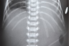 atelectasia-total-pulmonar-izq-tubo-endotraqueal-en-bronquio-der-cateter-art-umbilical-ven-femoral-1995-001