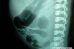 atresia-duodeno-doble-burbuja-down-2004-000