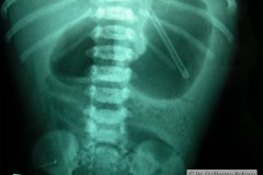 atresia-duodeno-doble-burbuja-down-2004-001