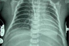 atresia-duodeno-pancreas-anular-neumoperitoneo-dren-000