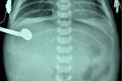 atresia-duodeno-pancreas-anular-neumoperitoneo-dren-001