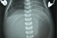 atresia-duodeno-pancreas-anular-neumoperitoneo-dren-002