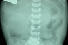 atresia-duodeno-pancreas-anular-neumoperitoneo-dren-003
