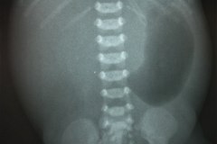 atresia-duodeno-pancreas-anular-neumoperitoneo-dren-004