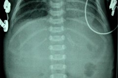 atresia-duodeno-pancreas-anular-neumoperitoneo-dren-005