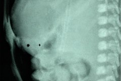atresia-duodeno-pancreas-anular-neumoperitoneo-dren-006