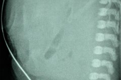 atresia-duodeno-pancreas-anular-neumoperitoneo-dren-007