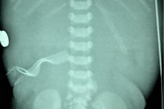 atresia-duodeno-pancreas-anular-neumoperitoneo-dren-008