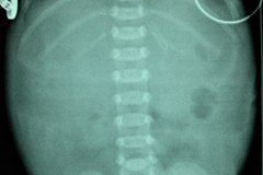 atresia-duodeno-pancreas-anular-neumoperitoneo-dren-009
