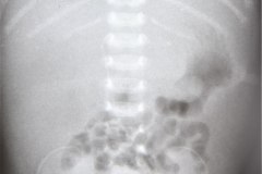 atresia-duodeno-perforacion-neumoperitoneo-atelectasia-sup-der-y-postop-1999-000