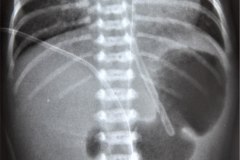 atresia-duodeno-perforacion-neumoperitoneo-atelectasia-sup-der-y-postop-1999-002
