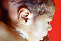 atresia-esofagica-fistula-traqueoesofagica-esofagostomia-gastrostomia-001