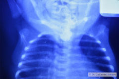 atresia-esofagica-fistula-traqueoesofagica-esofagostomia-gastrostomia-004