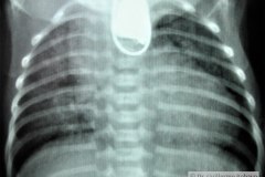 atresia-esofago-broncoaspiracion-liquido-claro-iatrogenia-salida-medio-contraste-de-la-sonda-1985-000