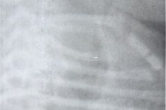 atresia-esofago-contraste-aire-fistula-traqueoesofagica-postop-estrechez-rge-1995-000