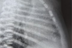 atresia-esofago-contraste-aire-fistula-traqueoesofagica-postop-estrechez-rge-1995-009
