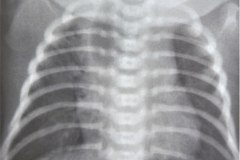 atresia-esofago-contraste-aire-fistula-traqueoesofagica-postop-estrechez-rge-1995-012