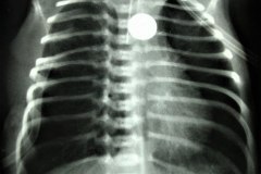 atresia-esofago-contraste-sonda-aire-pre-y-postop-000