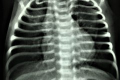 atresia-esofago-contraste-sonda-aire-pre-y-postop-001