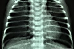 atresia-esofago-contraste-sonda-aire-pre-y-postop-003