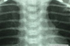 atresia-esofago-contraste-sonda-aire-pre-y-postop-005