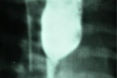 atresia-esofago-contrate-sonda-enrollada-dextrocardia-esofagograma-estrechez-postop-con-dilatacion-proximal-1992-000