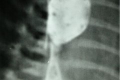 atresia-esofago-contrate-sonda-enrollada-dextrocardia-esofagograma-estrechez-postop-con-dilatacion-proximal-1992-002