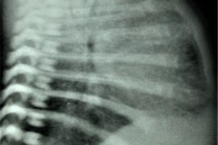 atresia-esofago-contrate-sonda-enrollada-dextrocardia-esofagograma-estrechez-postop-con-dilatacion-proximal-1992-005