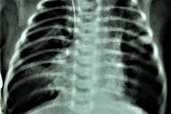 atresia-esofago-contrate-sonda-enrollada-dextrocardia-esofagograma-estrechez-postop-con-dilatacion-proximal-1992-006